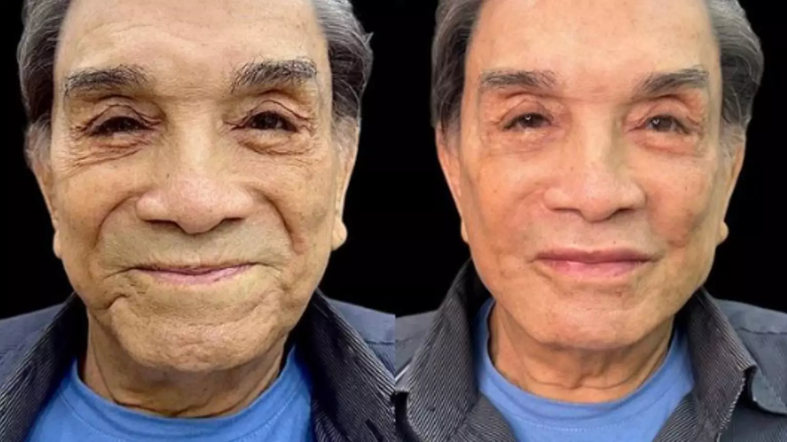 Aos 86 anos, Dedé Santana fez harmonização facial - (Fotos: Reprodução/Redes Sociais)